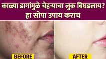 काळ्या डागांवर घरगुती उपाय| | How To get Rid Dark Spots On Face | Dark Spots Home Remedy