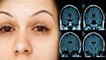 धुंधला दिखना दिमाग की इस Brain Tumor Symptoms , लक्षण पता चलने पर तुरंत कराए जांच |Boldsky*Health