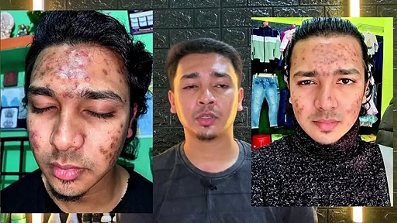 Importance Of Sunscreen In Acne Treatment Worst Sunscreen Mistake In Acne Routine Acne Treatment