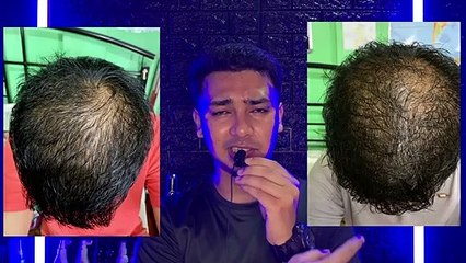 Keraglo Men Adgain Plus Hairbless Multivitamin Tablet 1 Month Before After Photos Genuine Review