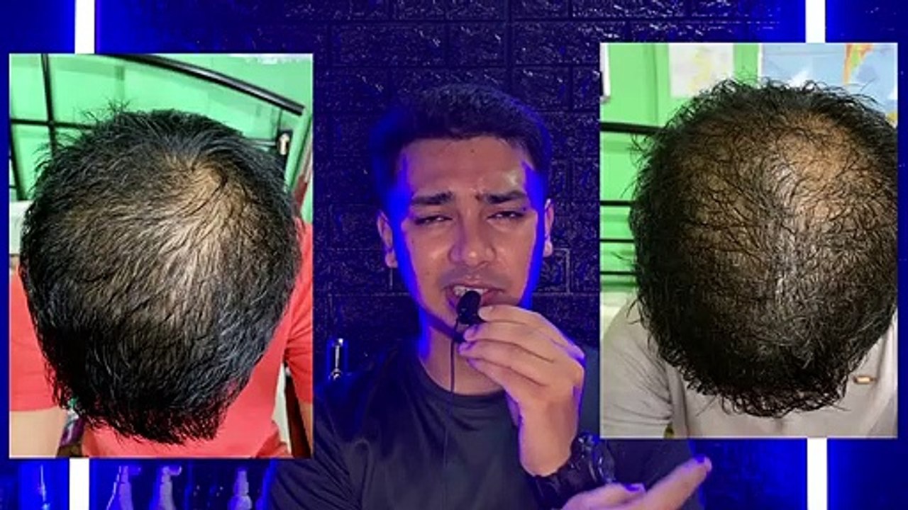 Keraglo Men Adgain Plus Hairbless Multivitamin Tablet 1 Month Before After Photos Genuine Review