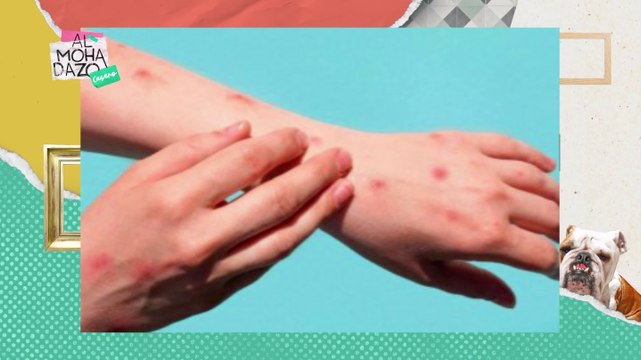 Más casos de viruela del mono - Almohadazo Casero