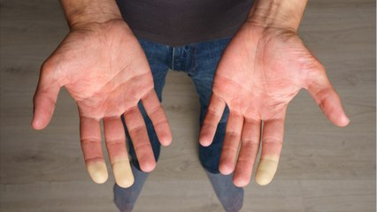 Syndrome de Raynaud : traitement, causes, diagnostic, de quoi s'agit-il ? (1)