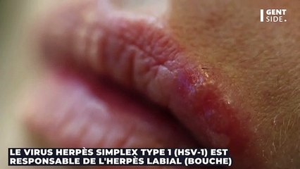 Qu'est-ce que l'herpès : symptômes, causes, traitement...de quoi s'agit-il ?
