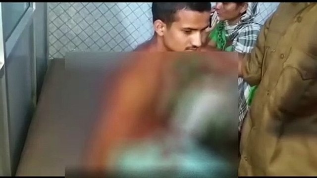 भावी 'अग्निवीर' पर एसिड अटैक: दौडऩे के लिए घर से निकले युवक पर पीछे से फेंका तेजाब, गंभीर हालत में रेफर