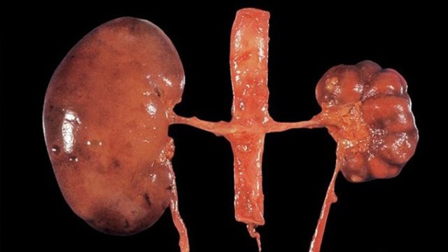 किडनी छोटा बड़ा होने से क्या होता है। किडनी छोटा बड़ा होने का कारण। Boldsky*Health
