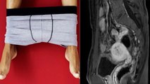 33 Age Chinese Man को Period, 22 Years से Menstruation | Boldsky*Health