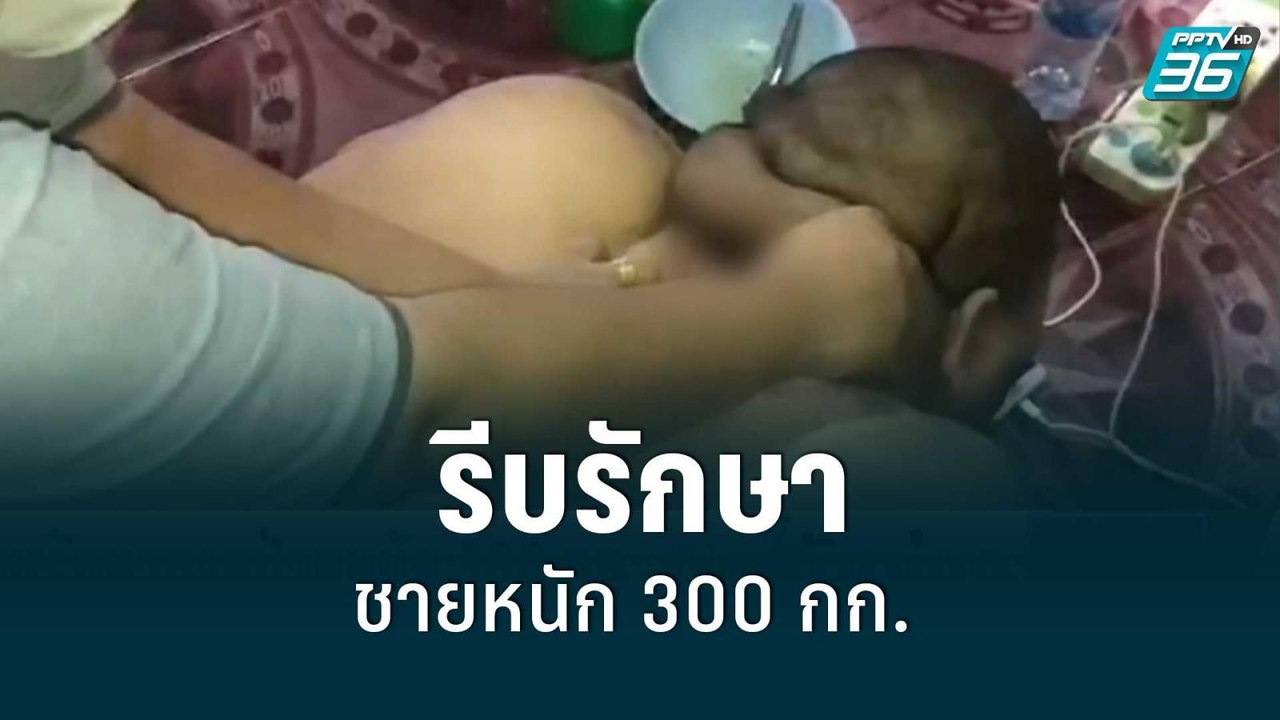 ทีมแพทย์เร่งวางแผน หวังรักษาชายป่วยโควิด น้ำหนั...
