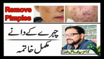 Face Pimples chahrey k dane Homeo Treatment  Dr. Syed Muhammad Danish Shah