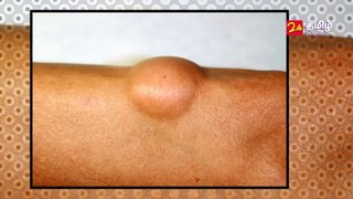 Lipoma Treatment in Tamil - Kolupu Katti கொழுப்பு கட்டி கரைய மருந்து