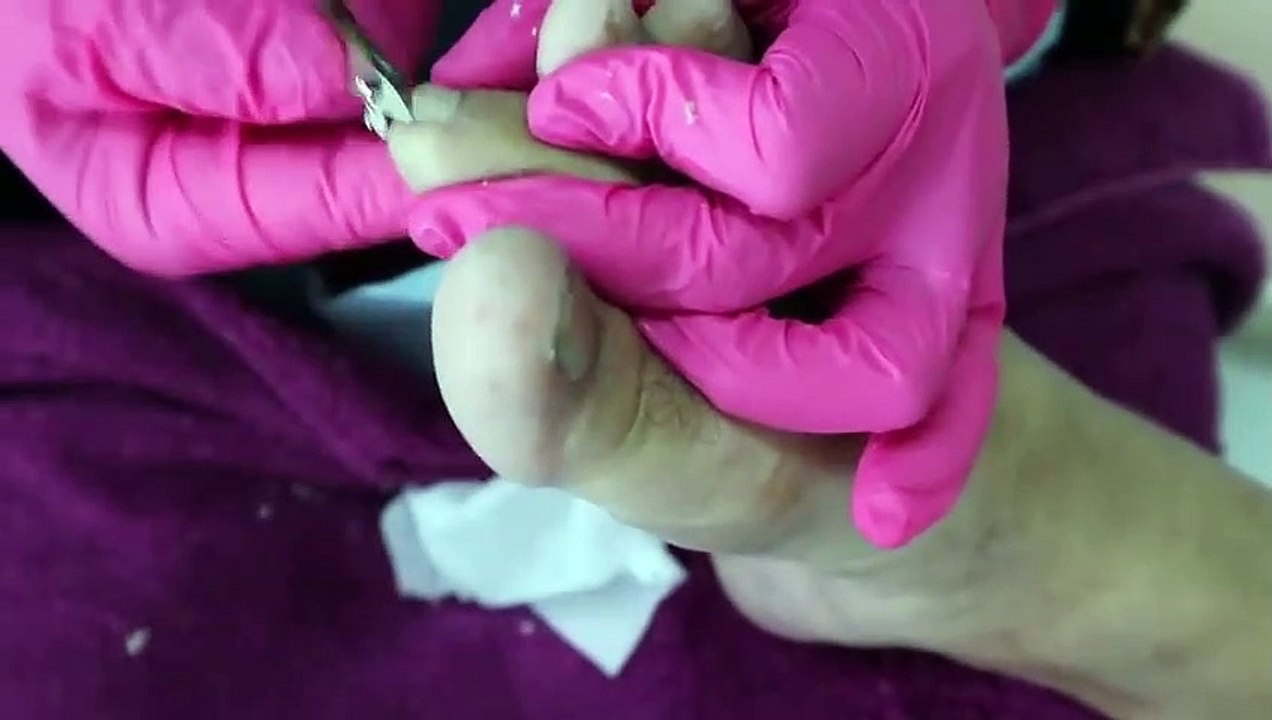 HOW TO CUT THICK TOENAILS - Toenail Cleaning Satisfying #1