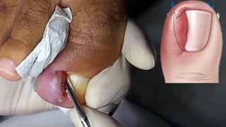 HOW TO CUT THICK TOENAILS - Toenail Cleaning Satisfying #4