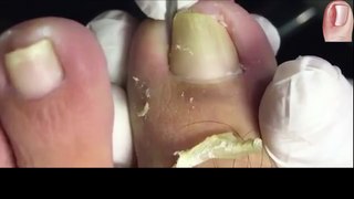 HOW TO CUT THICK TOENAILS - Toenail Cleaning Satisfying #6