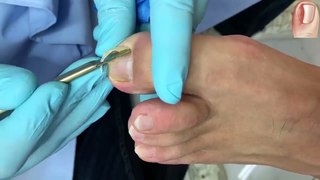 HOW TO CUT THICK TOENAILS - Toenail Cleaning Satisfying #7