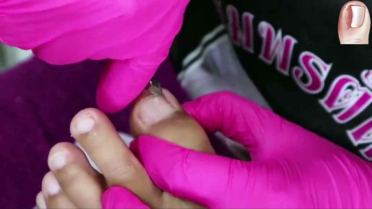 HOW TO CUT THICK TOENAILS - Toenail Cleaning Satisfying #11