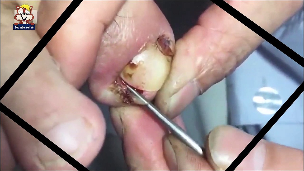 HOW TO CUT THICK TOENAILS - Toenail Cleaning Satisfying #12