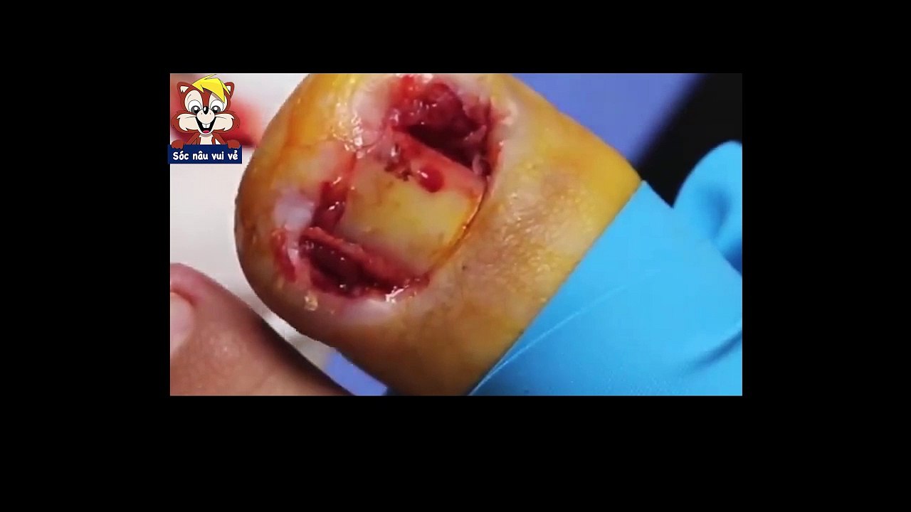 HOW TO CUT THICK TOENAILS - Toenail Cleaning Satisfying #13
