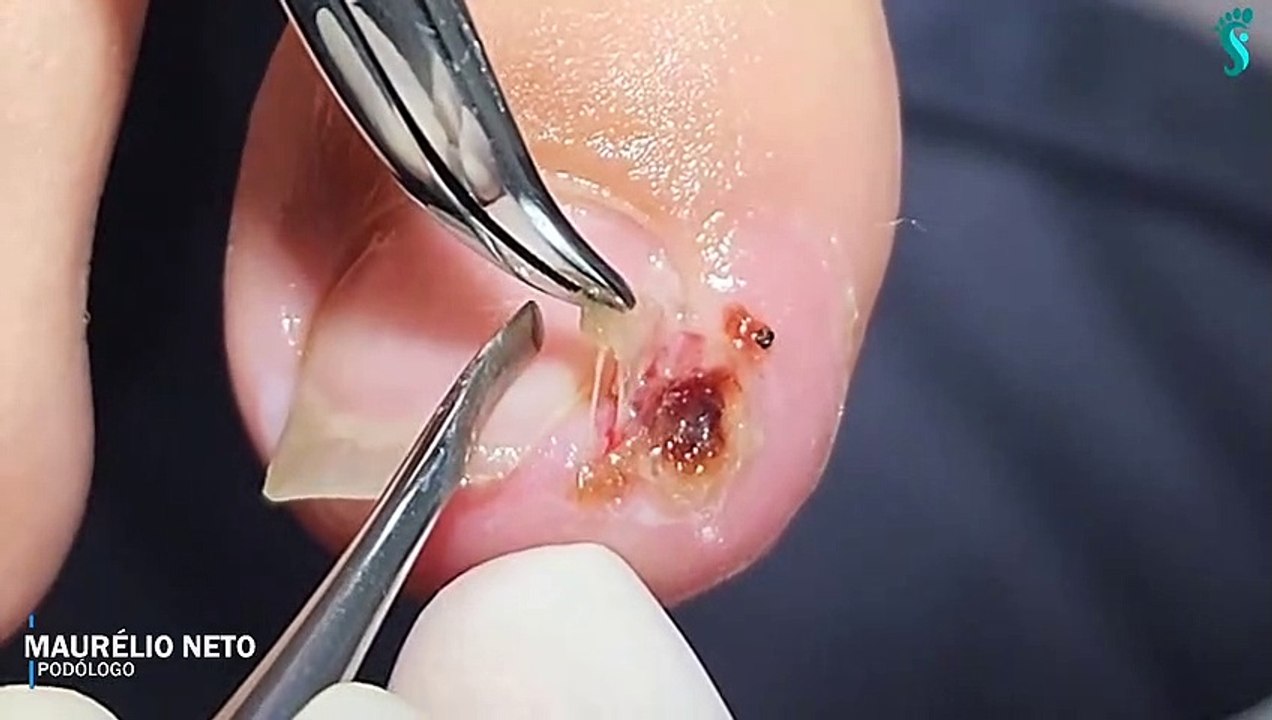HOW TO CUT THICK TOENAILS - Toenail Cleaning Satisfying #15
