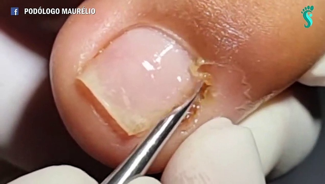 HOW TO CUT THICK TOENAILS - Toenail Cleaning Satisfying #16
