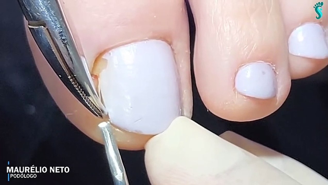 HOW TO CUT THICK TOENAILS Toenail Cleaning Satisfying 17 Video Dailymotion
