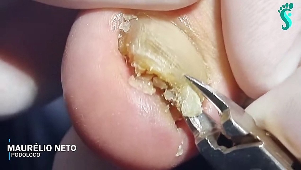 HOW TO CUT THICK TOENAILS - Toenail Cleaning Satisfying #18