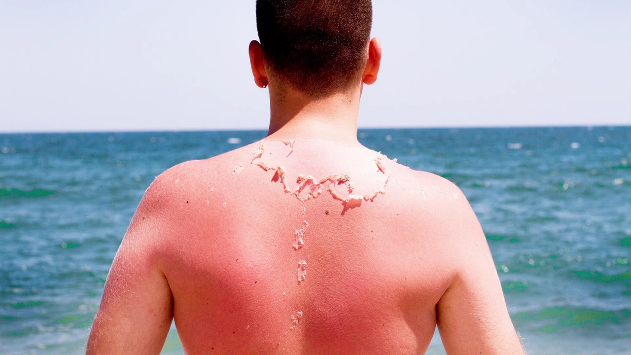 Schützt schatten wirklich vor sonnenbrand?