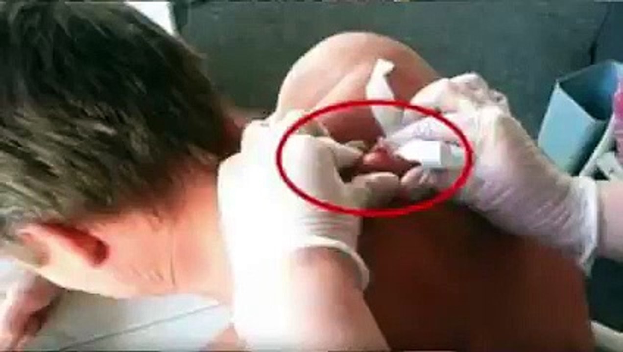 Kenapa Badan Kita Selalu Dijangkiti Bisul_