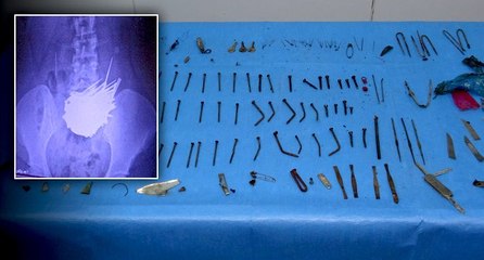 Doktorları şaşkına çeviren ameliyat: Midesinden 158 parça metal çıktı
