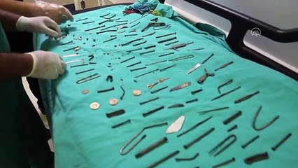 Kadın hastanın midesinden 158 yabancı cisim çıkarıldı