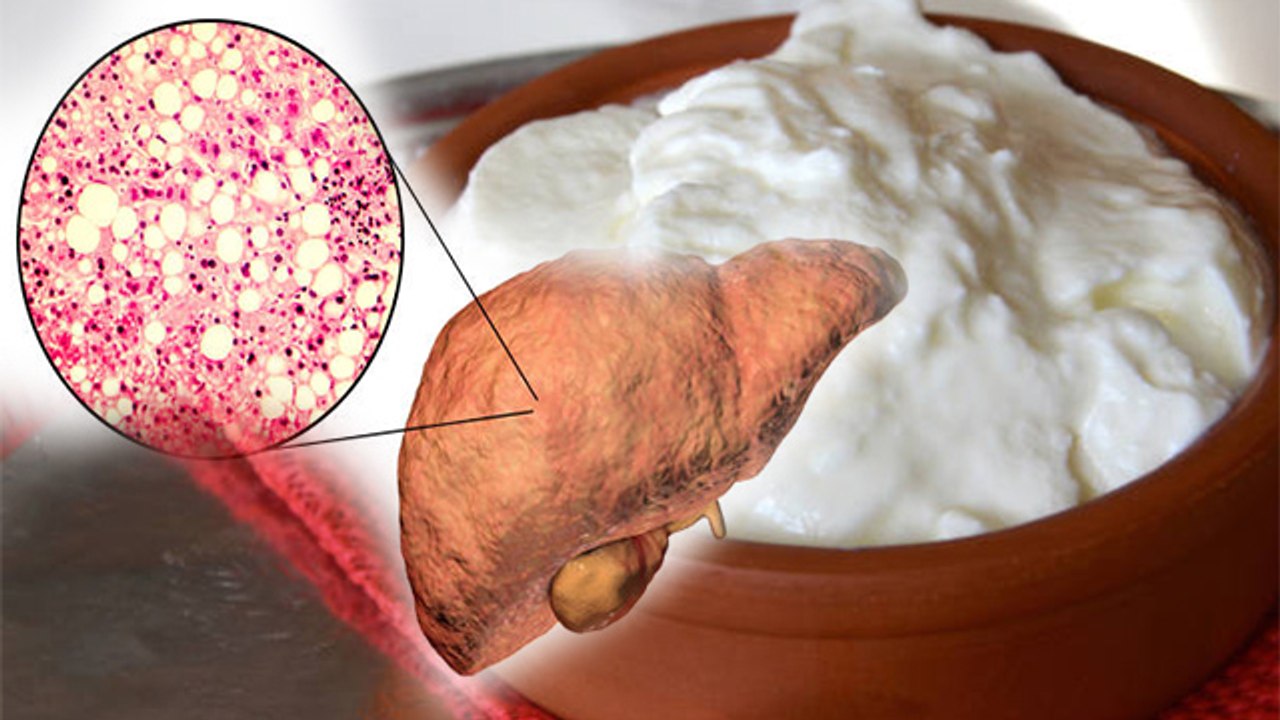 फैटी लिवर में दही खाना चाहिए या नहीं, Is Curd Good for Fatty Liver | Boldsky *Health