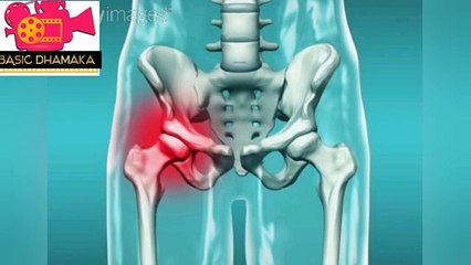 হিপ জয়েন্টের সমস্যা _ Problem in HIP Joint AVN কেন কি কারণে হিপ জয়েন্টের সমস্যা হয় জানুন বিস্তারিত - YouTube