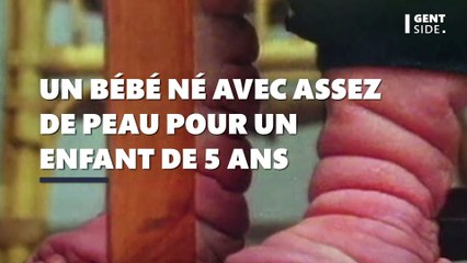 Ce bébé unique au monde est né... avec assez de peau pour un enfant de 5 ans