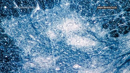 US reports 1st polio case in nearly a decade