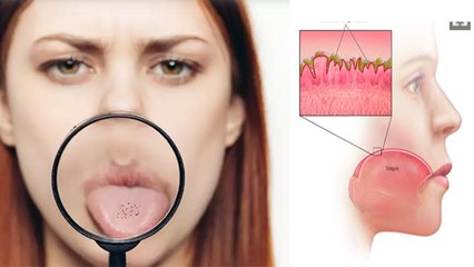 जीभ में काले धब्बे पड़ने का कारण | Jeebh Par Kala Dhabba Ka Karan | Boldsky *Health