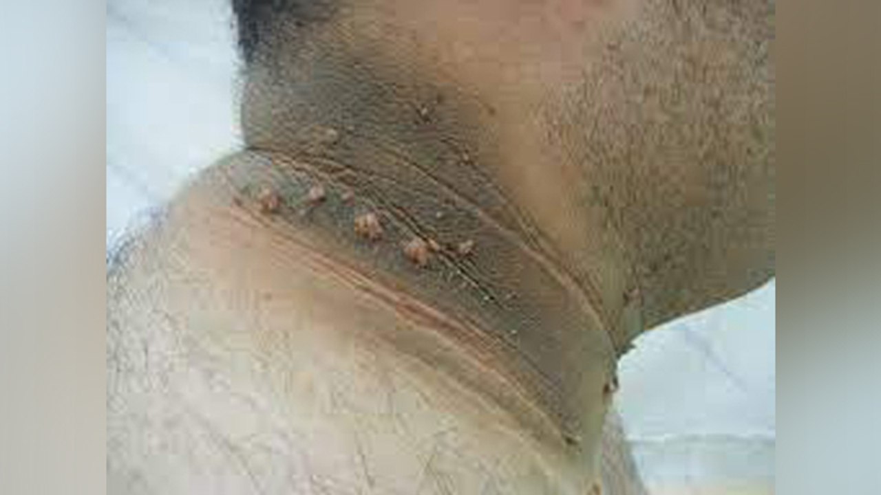 Neck पर Black Spot Insulin Resistance बीमारी,Symptoms Reasons चौंकाने वाले । Boldsky *Health