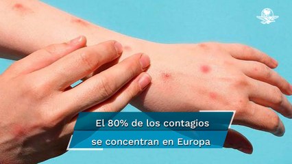 Viruela del mono. OMS declara el brote como emergencia internacional
