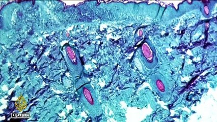 WHO: Monkeypox Global Health Emergency