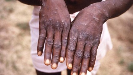 Delhi Man with no history of foreign travel tests positive for monkeypox