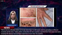 Biggest Monkeypox Study To Date Contains Hundreds Of Pictures And Details New Symptoms - 1breakingne