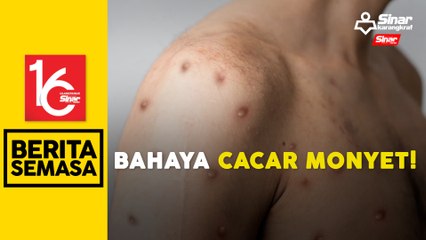 Segera ke fasiliti kesihatan jika ada gejala cacar monyet: Khairy