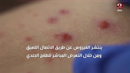 معلومات يجب أن تعرفها عن جدري القرود بعد إعلانه حالة طوارئ عالمية