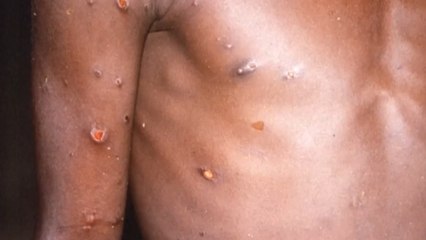 ¿Cuánto tiempo debería aislarse una persona con síntomas de viruela del mono?