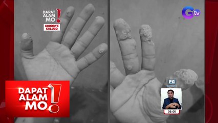 Bakit nga ba tinutubuan ng kulugo ang balat ng tao? | Dapat Alam Mo!