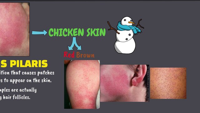 Home remedies to get rid of keratosis Pilaris (patchy skin)