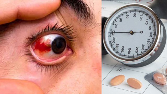 आंखों से खून आना High Blood Pressure का कारण। Symptoms है चौंकाने वाले। Boldsky *Health
