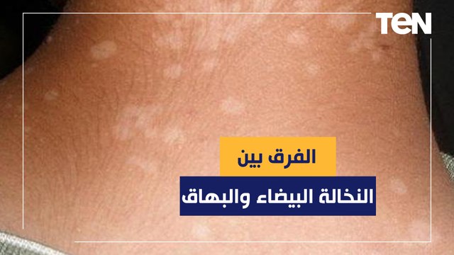 الدكتور هاني الناظر يكشف الفرق بين النخالة البيضاء والبهاق
