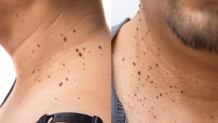 गर्दन पर मस्से क्यों होते है । गर्दन पर मस्से होने का कारण । Boldsky *Health