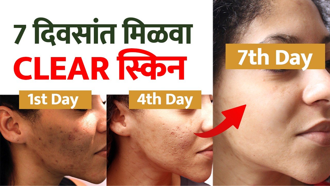 क्लिअर स्किनसाठी करा हे  घरगुती उपाय | 7 Days Clear Skin Challenge | How To Get Clear Skin Naturally