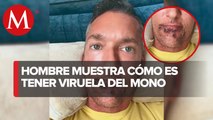 Hombre narra su experiencia tras contagio de viruela del mono: 