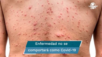 Descartan que viruela símica se propague extensamente como el Covid-19